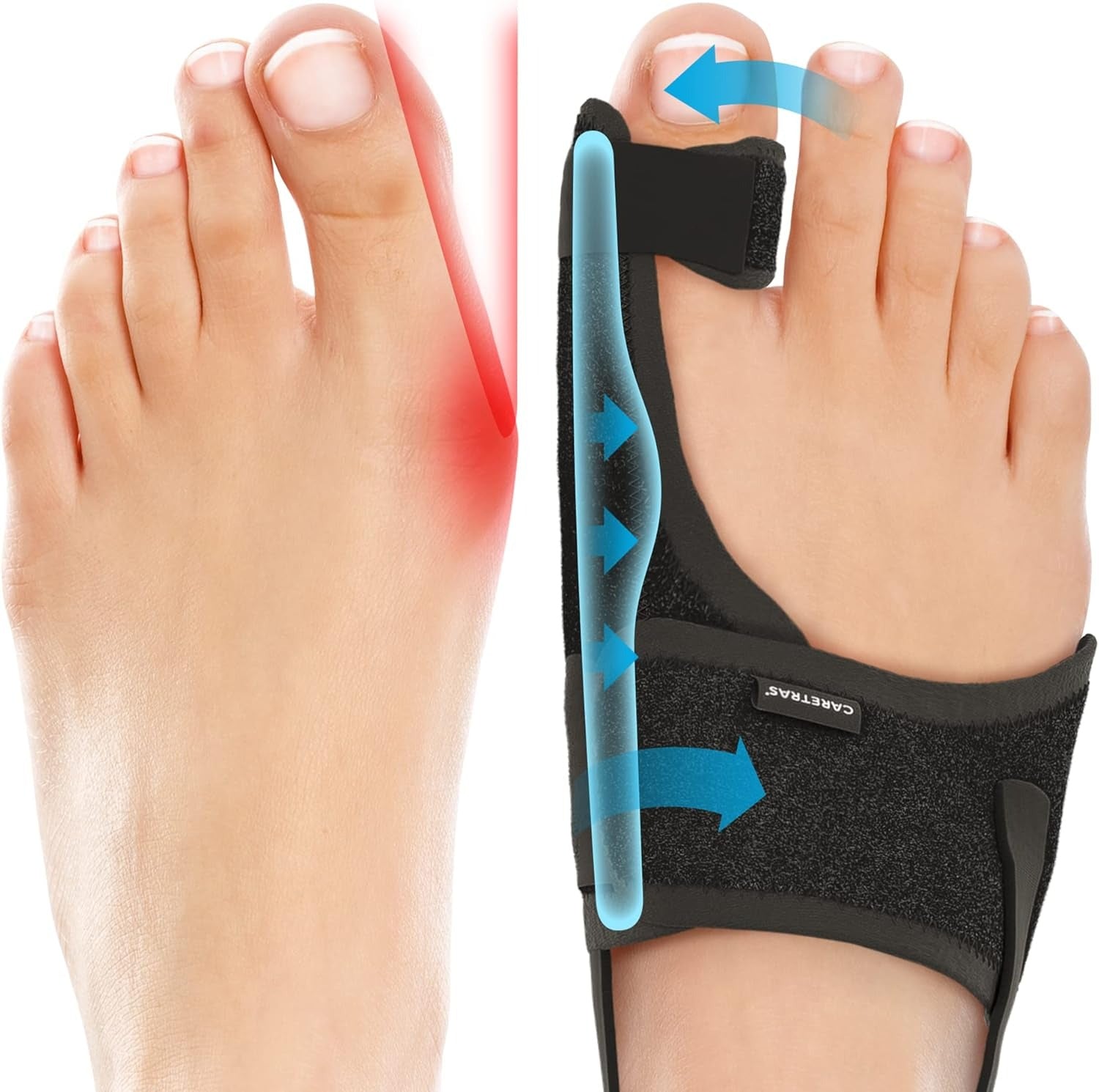 2-Pack Adjustable Bunion Corrector – Day & Night Big Toe Support