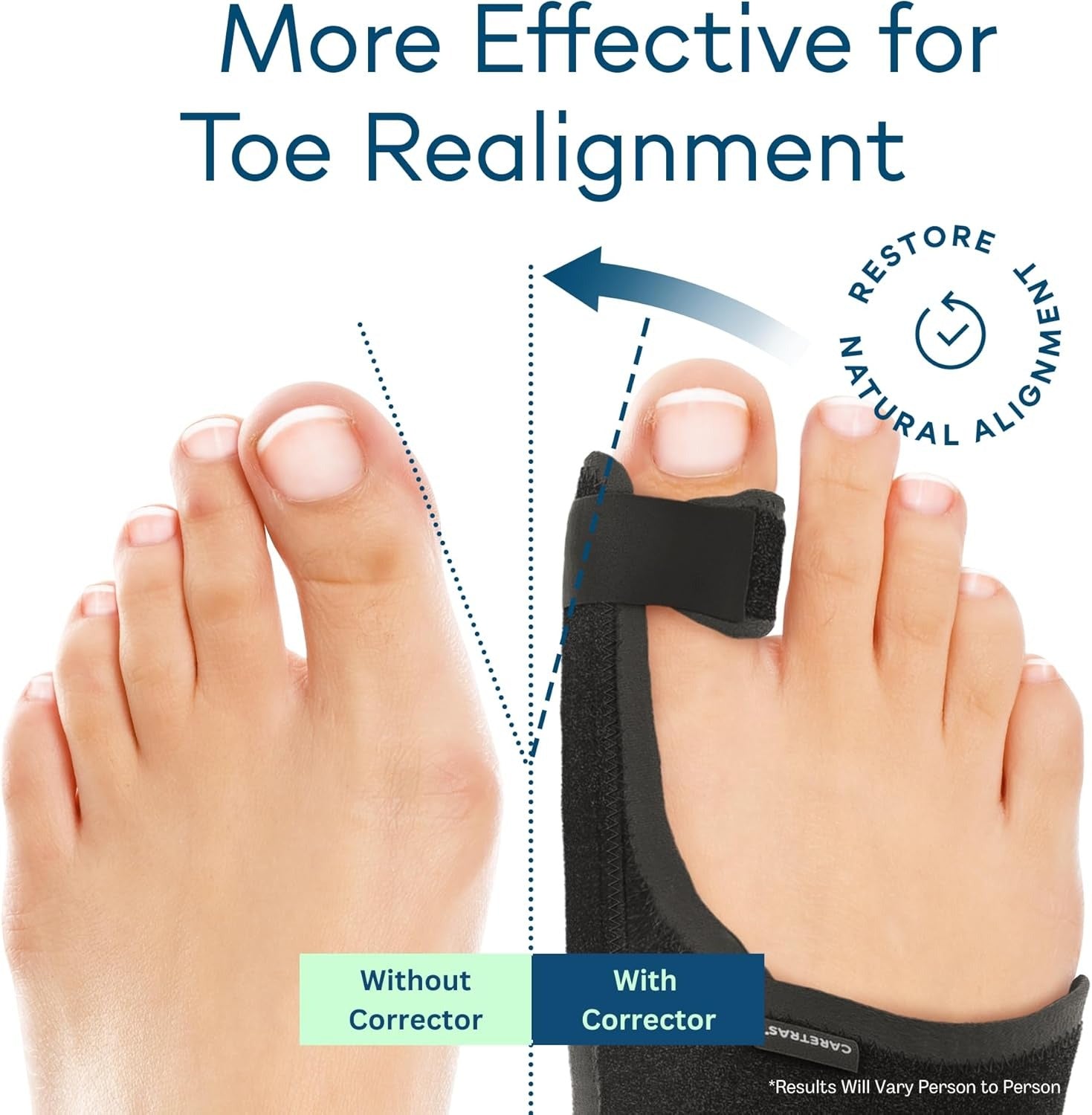 2-Pack Adjustable Bunion Corrector – Day & Night Big Toe Support