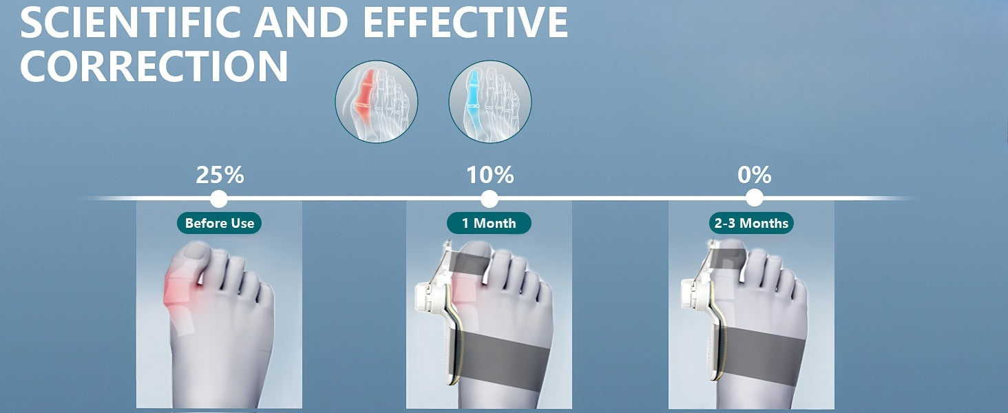 Adjustable Bunion Corrector for Women & Men | Big Toe Alignment Support
